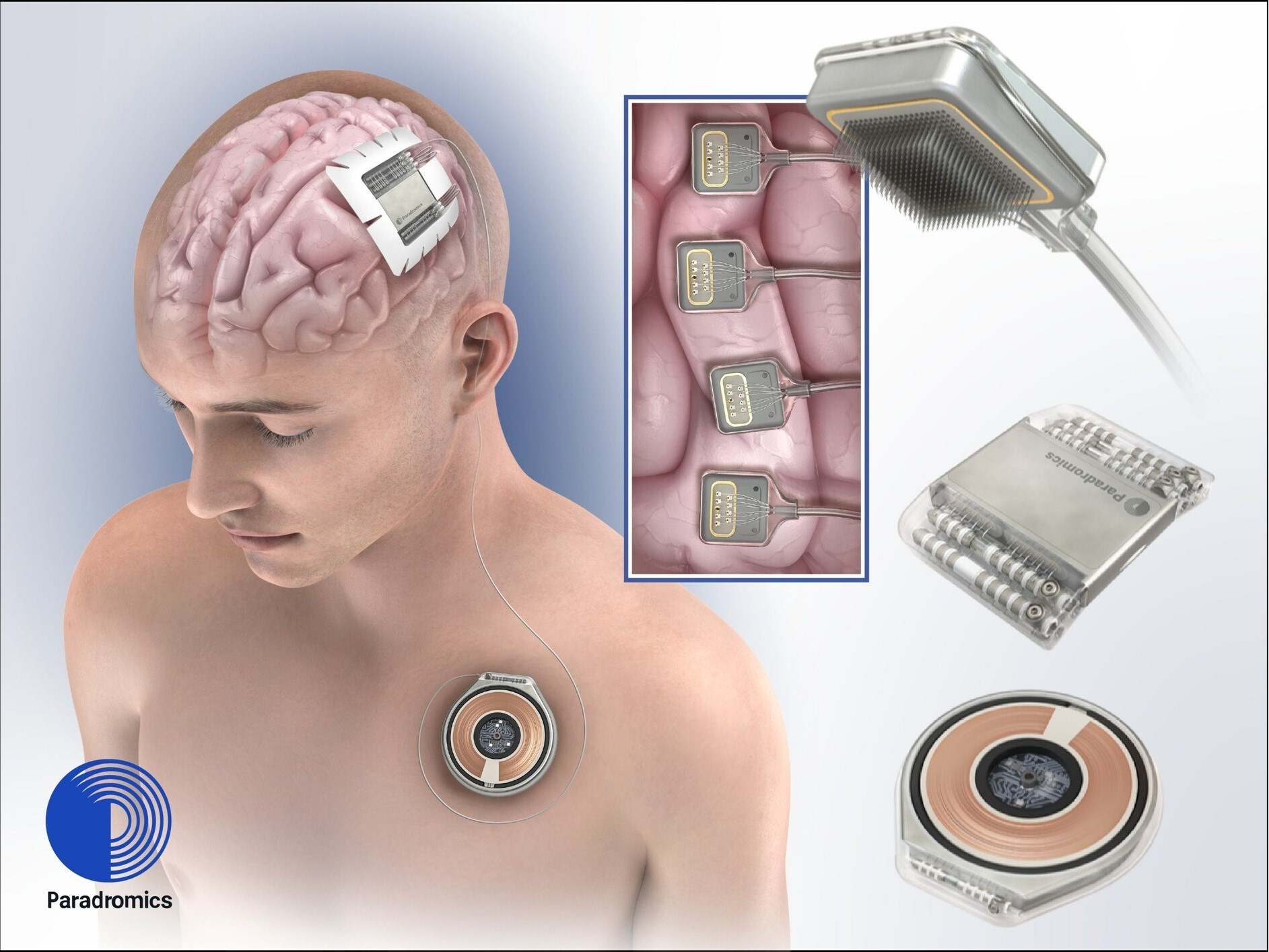 neuralink rakibi paradromics beyin bilgisayar arayuzunu birinci defa bir besere uyguladi 1 QSMtus75